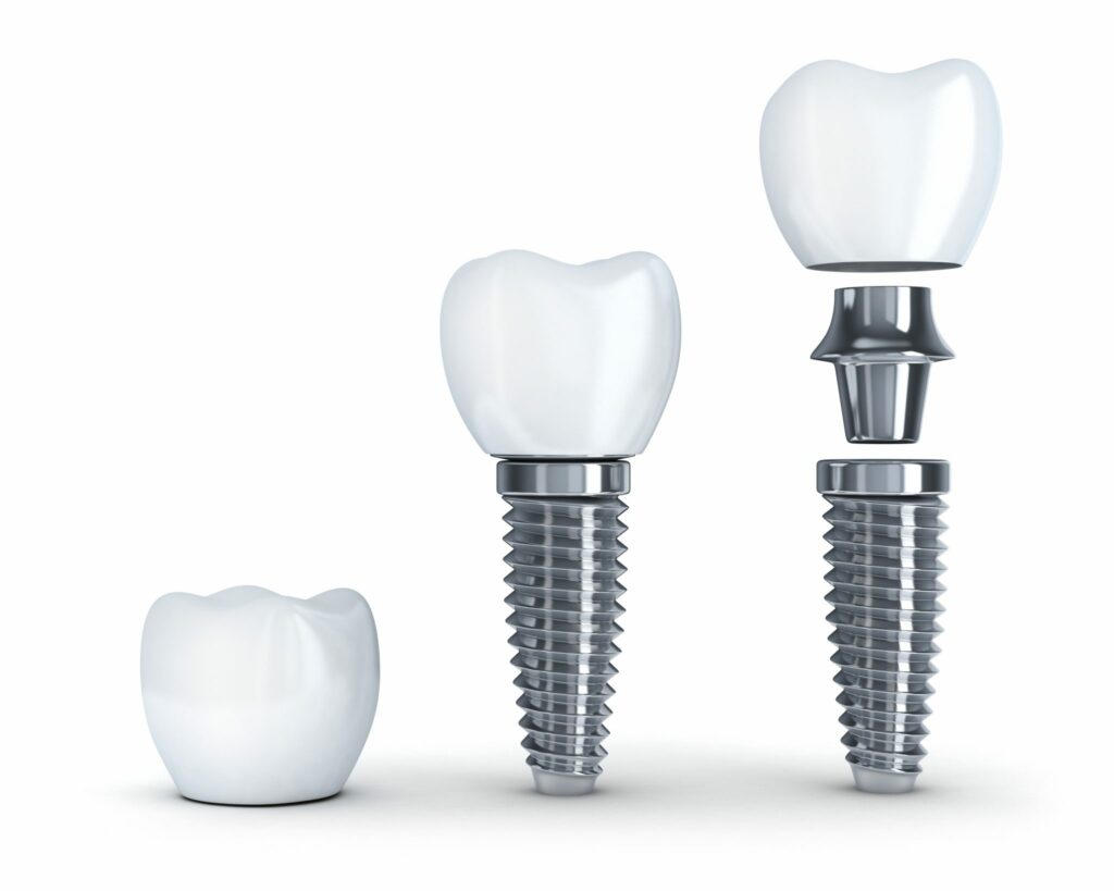 Tooth implant disassembled