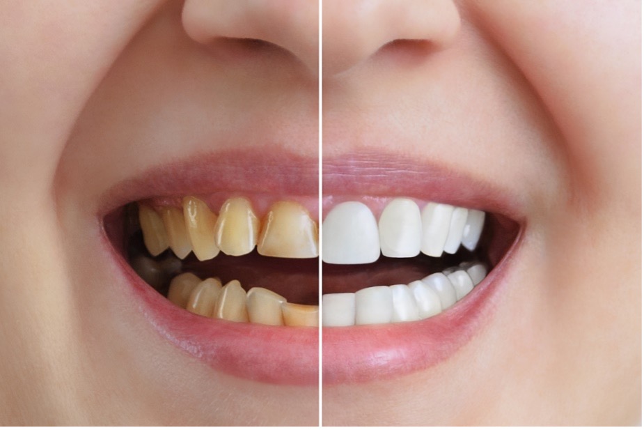 Before and after cosmetic dentistry