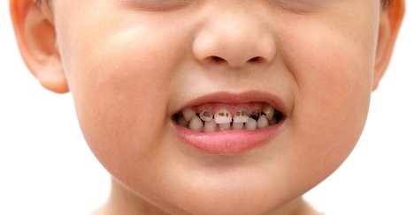 Child with many cavities